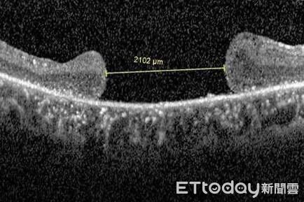 ▲手術前的光學電腦斷層掃描圖顯示，吳先生的黃斑部裂孔已達2100微米。（圖／慈濟醫學中心提供，下同）