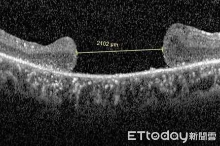 ▲手術前的光學電腦斷層掃描圖顯示，吳先生的黃斑部裂孔已達2100微米。（圖／慈濟醫學中心提供，下同）