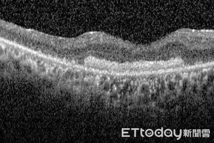 ▲手術前的光學電腦斷層掃描圖顯示，吳先生的黃斑部裂孔已達2100微米。（圖／慈濟醫學中心提供，下同）