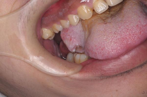 ▲▼有患者因舌側反覆刮傷，演變成舌癌。（圖／牙醫師曹皓崴提供）