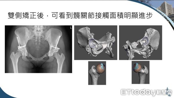 ▲▼雙側矯正後，可看見髖關接觸面積已擴大許多。（圖／台北榮總提供）