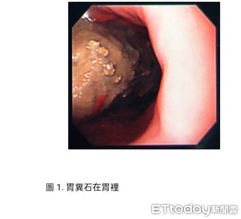 ▲長期腹痛、消化不良　新竹阿公胃裡竟長出石頭。（圖／台北榮民總醫院新竹分院提供）