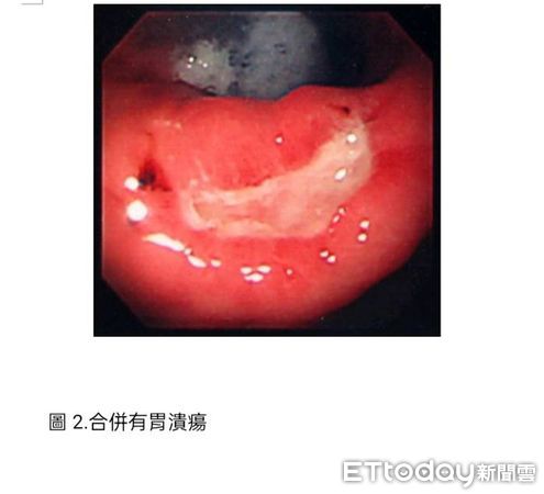 ▲長期腹痛、消化不良　新竹阿公胃裡竟長出石頭。（圖／台北榮民總醫院新竹分院提供）