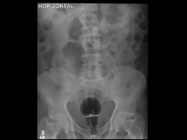 ▲▼哥倫比亞一名53歲男性患者將燈泡塞入肛門，卡在腸子裡。（圖／翻攝自推特／@eljulii37）