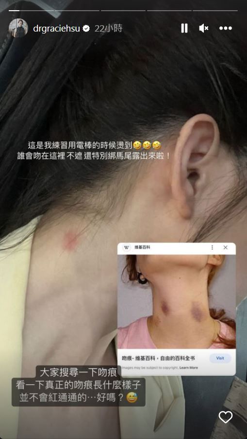 ▲許藍方回應脖子紅色傷痕。（圖／翻攝自Instagram／drgraciehsu）