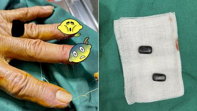 賭客兩根手指植入磁鐵40年！　最近要搭機怕安檢不過才求醫生移除