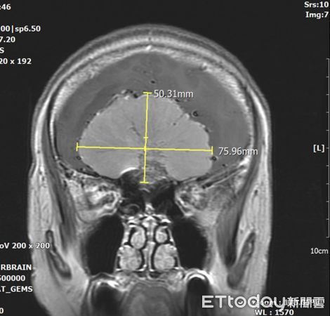 台北慈濟醫院神經外科李定洲醫師,8公分腫瘤。（圖／院方提供）
