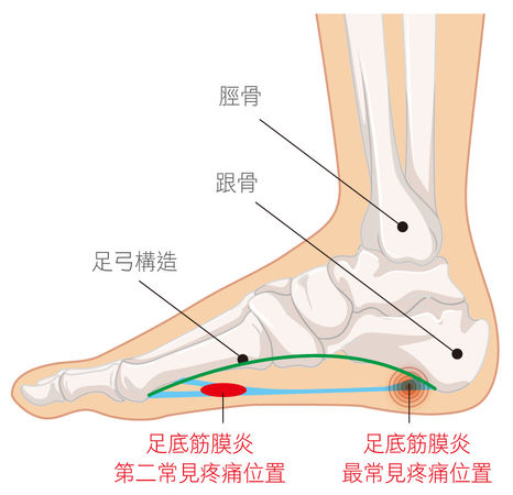 長時間走路可在鞋內加鞋墊，弧度與足弓貼合，緩衝踩地的壓力，避免產生足底筋膜炎。（圖／醫師提供）