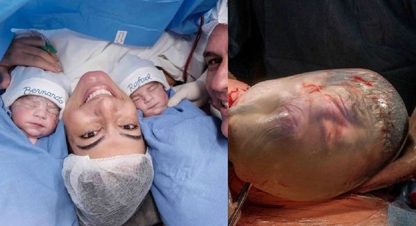 求子14年終於懷雙胞胎　女產下罕見「人魚寶寶」男嬰包羊膜囊出生。（圖／翻攝自Instagram／renatacasalifotografia）