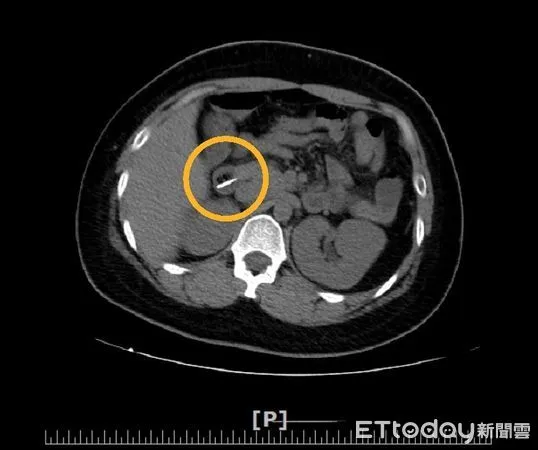 ▲黃圈處為電腦斷層影像，可看見誤食入體內的牙刷刷頭。（圖／衛福部南投醫院提供）