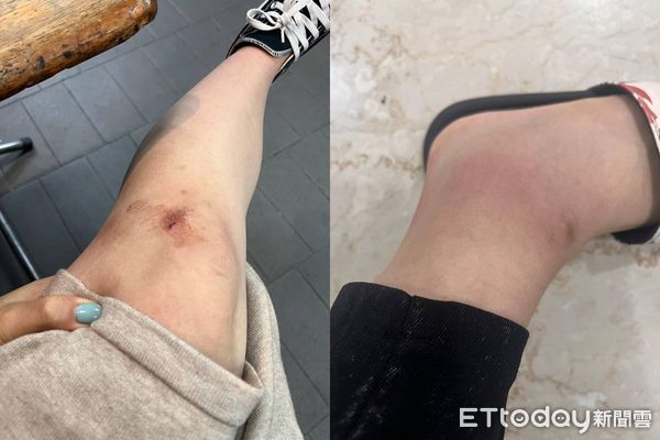 ▲走在騎樓「整座招牌塌陷掉下」　被砸傷蕭姓民眾呼籲：餐廳請重視行人安全。（圖／蕭小姐提供）