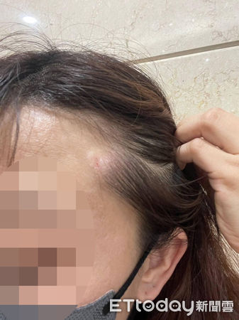 ▲走在騎樓「整座招牌塌陷掉下」　被砸傷蕭姓民眾呼籲：餐廳請重視行人安全。（圖／蕭小姐提供）