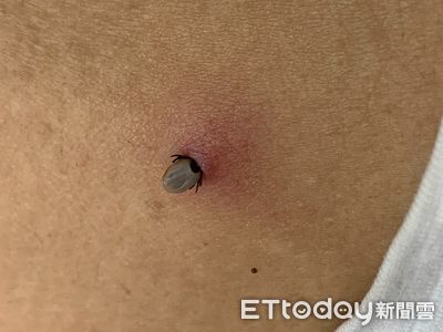高雄婦遊日返國肩痛...皮膚黑線頭竟是蜱蟲!醫憂變萊姆病