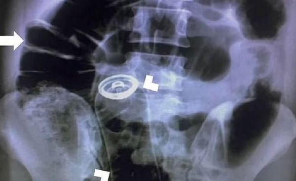 男追求快感搞到肚子痛　X光照出「整罐體香劑」從直腸滑進胃裡面。（圖／翻攝自ScienceDirect網站）