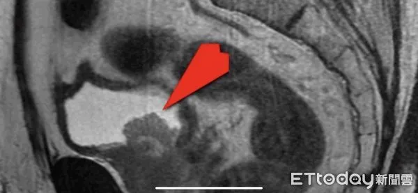 ▲核磁共振影像中紅色箭頭所指，顯示病人攝護腺腫瘤已侵犯膀胱。（圖／慈濟醫學中心提供，下同）