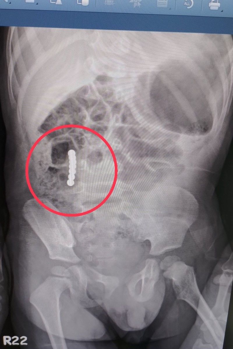 ▲▼透過X光檢查，發現男童體內有7顆疑似具有強力磁性的巴克球。（圖／輔大醫院提供）