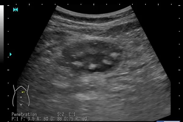 ▲▼陳敬倫醫師曬出珍珠在胃裡的超音波圖片。（圖／翻攝自Facebook／臭寶爸 - 兒科陳敬倫醫生）