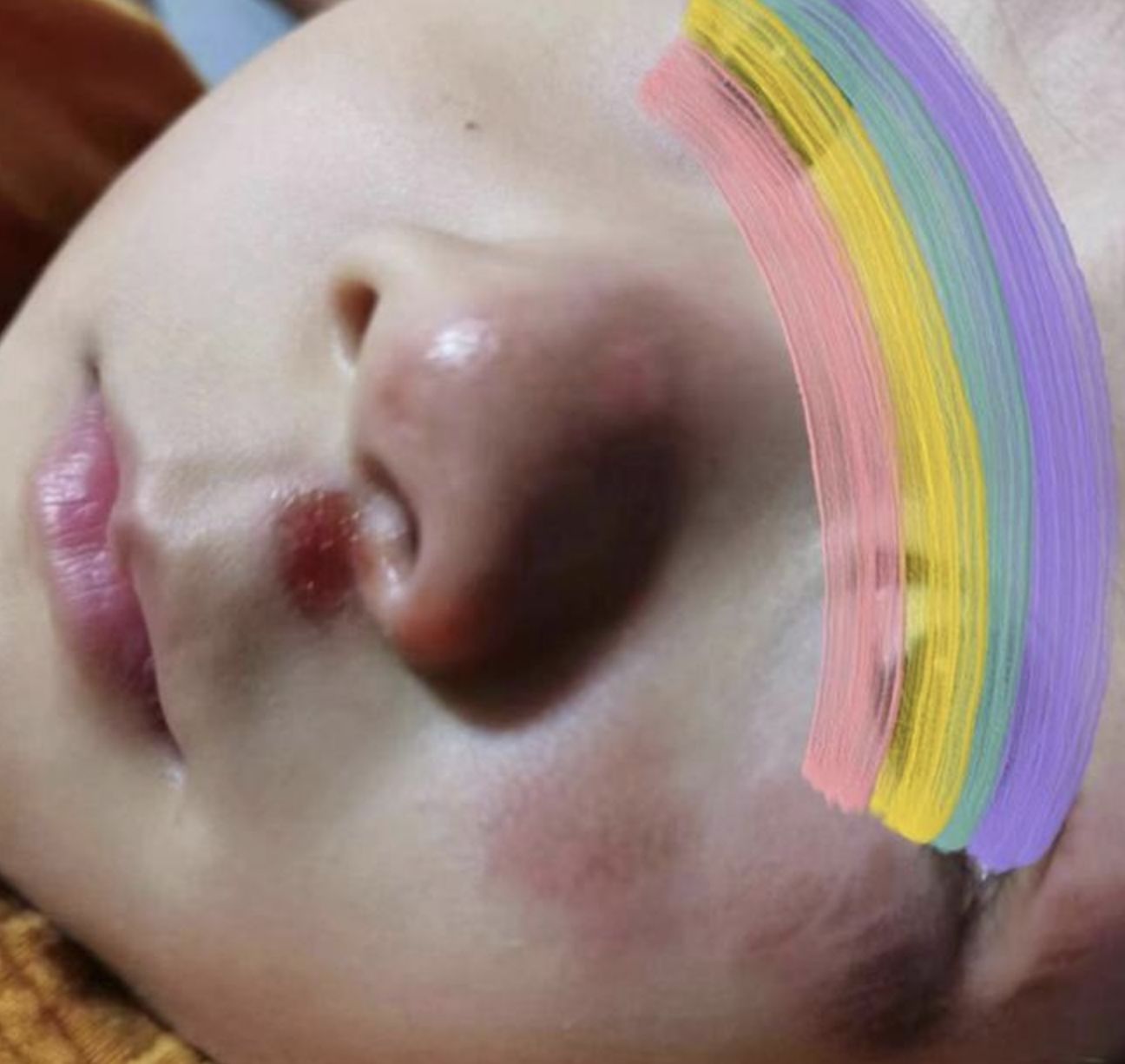 ▲女童在上海迪士尼排隊時被插隊黃牛推擠，造成臉部大面積挫傷。（圖／囡設上游新聞）