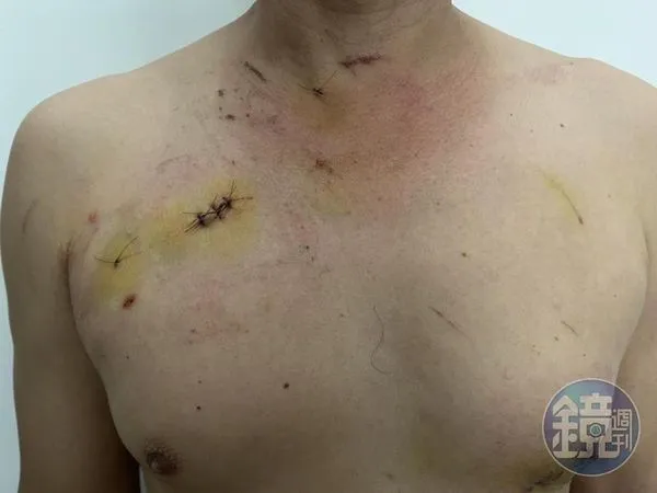 受害華男左右胸和頸部都被刺傷，險些丟了性命。（讀者提供）