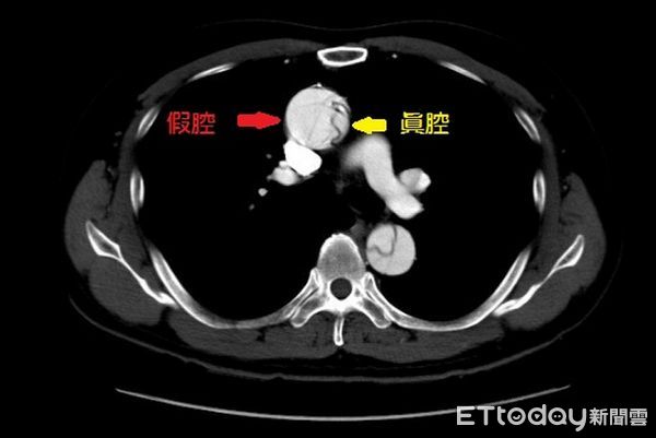 主動脈內層破裂產生縫隙時，血流會將主動脈撕裂成「假腔」與「真腔」兩個腔室。（圖／台北慈濟醫院提供）