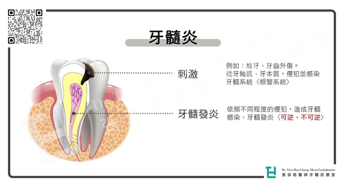 ▲牙髓炎簡單來說，就是牙齒內部的牙髓，遭到刺激，而我們人體的免疫系統對這些刺激的反應，就是發炎。（圖／張添皓醫師牙髓診療室提供）