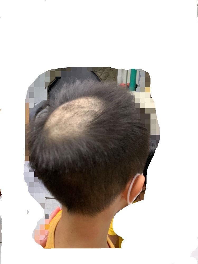 ▲新北市一名男童因為檢驗而剃髮，頭頂光了一大塊。（圖／受害者聯盟粉專授權提供）