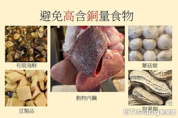 ▲▼威爾森氏症應避免飲食。（圖／長庚醫院提供）