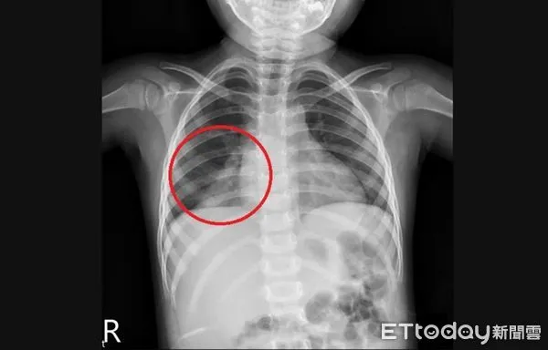 ▲3歲女童高燒5天X光一照已「肺浸潤」，兒科醫警告：5大魔王病毒正肆虐。（圖／亞大醫院提供）