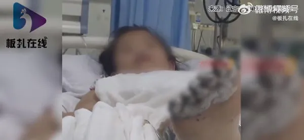 ▲女孩腳趾焦黑一片，令人看了心痛憐惜。（圖／翻攝微博）