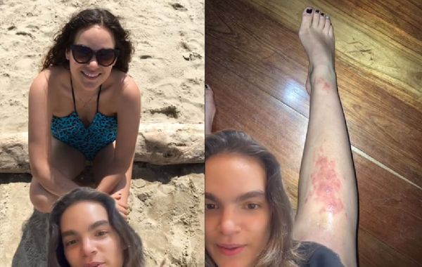 去完海邊腿突然冒「詭異紅疹」　27歲女就醫崩潰：寄生蟲大量產卵。（圖／翻攝自TikTok／doscabraslocas）