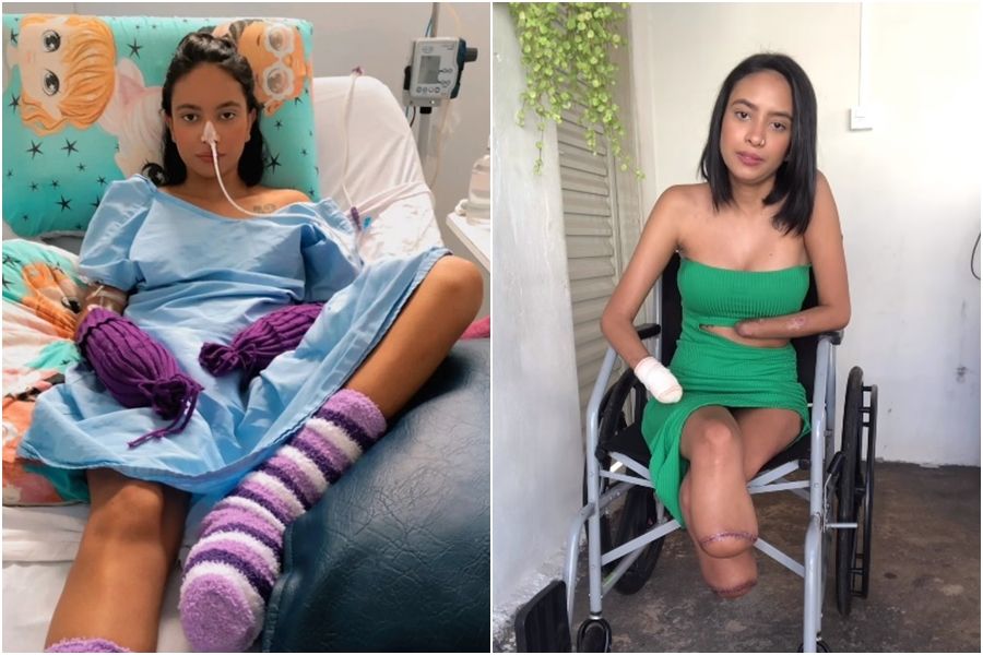 泌尿道感染擴散爆痛！　20歲妹昏迷6天醒來「手腳截肢」 | ETtoda