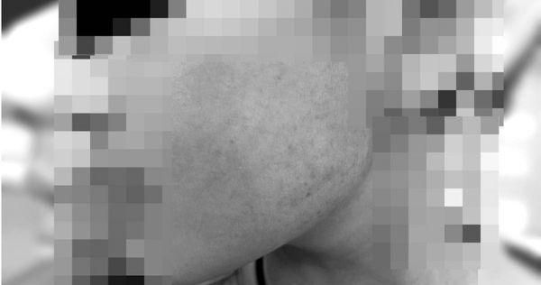 孩子臉部瘀青。（圖／翻攝自臉書／嘎老師 Miss Ga）