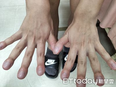 看指甲揪出肺癌！中年男易喘「指尖像鼓棒」　醫示警5大變色警訊