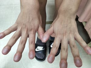 看指甲揪出肺癌！中年男易喘「指尖像鼓棒」　醫示警5大變色警訊