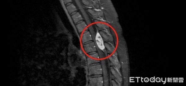 ▲核磁共振檢查，發現廖小姐的胸椎第四、五節空腔有顆三公分大的腫瘤，已嚴重壓迫神經。（圖／慈濟醫學中心，下同）