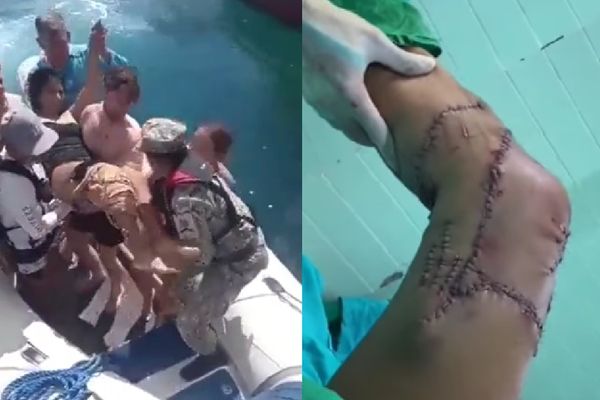 被鯊魚咬了沒感覺　女護士浮潛「周圍海水被染紅」恐怖傷勢曝光。（圖／翻攝自Facebook）