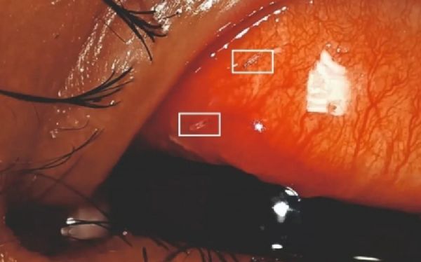 10歲童眼睛刺痛竟是「蒼蠅產卵」　醫生一口氣清出11隻蠕動蛆蟲。（圖／翻攝自Twitter）