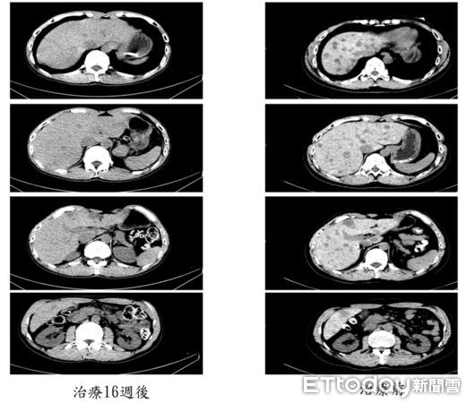 ▲▼病人治療前後影像檢查:治療後 16 週可見胰臟及肝臟之腫瘤體積明顯縮小。（圖／三總提供）