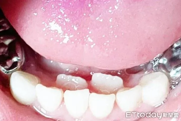 6歲孩童長出雙排牙齒。（圖／院方提供）