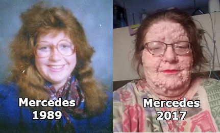 ▲▼美國愛達荷州52歲婦人克莉斯汀森（Mercedes Christensen）罹患神經纖維瘤病1型罕病。（圖／翻攝自Facebook／Mercedes Christesen）