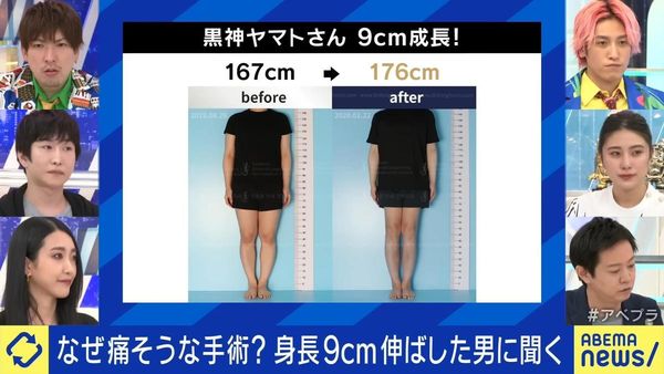 黑神YAMATO透過手術增高9公分。（翻攝自《ABEMA Prime》）