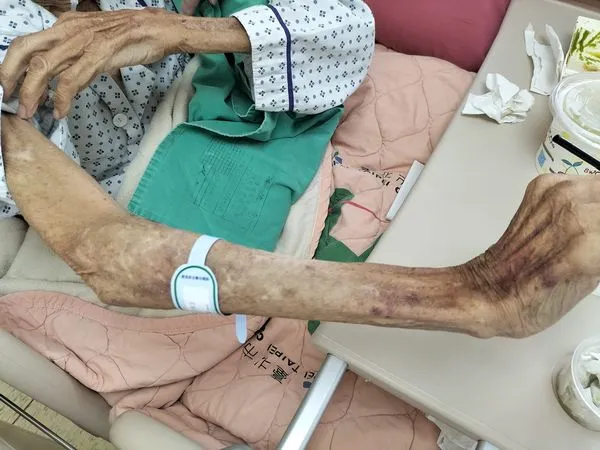 ▲爺爺手臂瘦成竹竿。（圖／翻攝自臉書／蘇一峰）