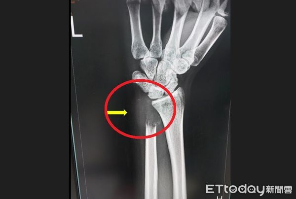 ▲24歲男患罕見「骨巨細胞瘤第三期」，手無力就醫照X光：骨頭被癌細胞吃空。（圖／烏日林新醫院提供）