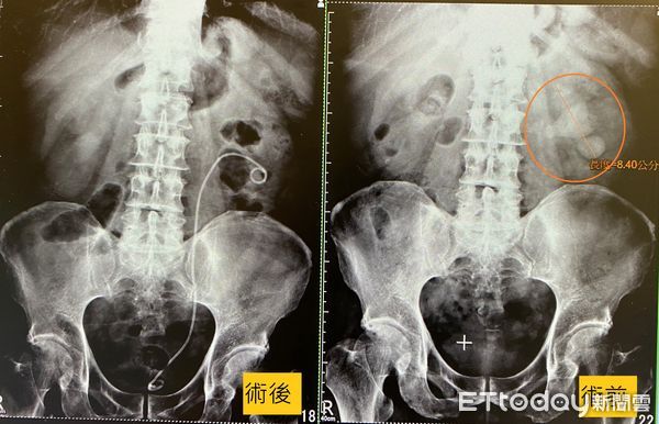 ▲跑步就血尿！男子腎結石沒追蹤竟成8.4公分巨無霸鹿角石，醫：再拖恐洗腎。（圖／長安醫院提供）