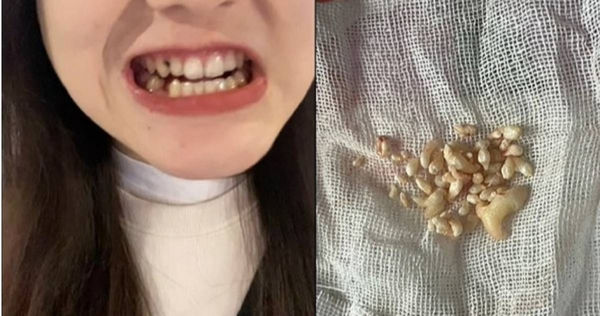 女子罹患罕病「牙瘤」並清出57顆牙齒。（圖／翻攝自抖音）
