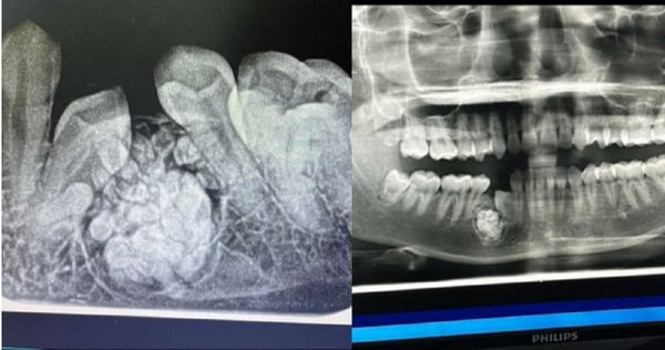 女子的全牙與局部X光照。（圖／翻攝自抖音）