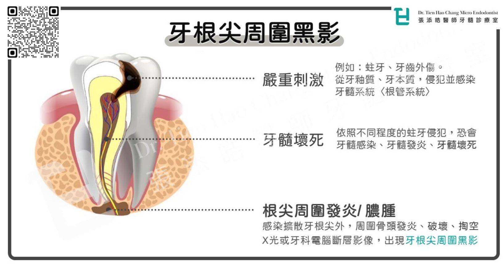 牙根尖黑影。（圖／張添皓醫師提供）