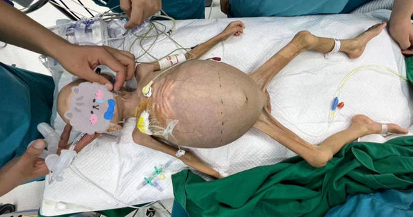 中國一名2歲女童罹患「兒童癌王」神經母細胞腫瘤，肚子膨脹像快爆炸的氣球。（圖／翻攝自搜狐健康）