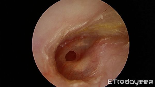 耳膜破,台北慈濟醫院耳鼻喉科鄭靜雯醫師。（圖／記者趙于婷攝）