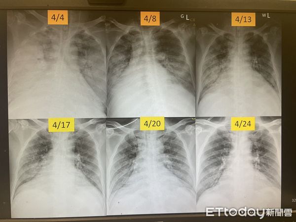 ▲病人治療前與治療後的胸部X光片影像，原本大片白化的肺部（上），治療後恢復正常（下）。（圖／慈濟醫學中心提供，下同）